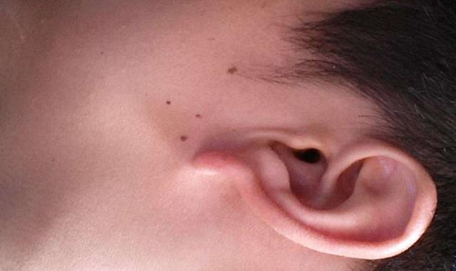 激光点痣有效果吗  多久可以恢复
