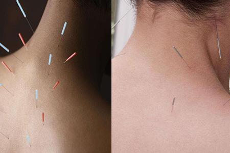 针灸减肥多久能瘦下来 了解这些很重要