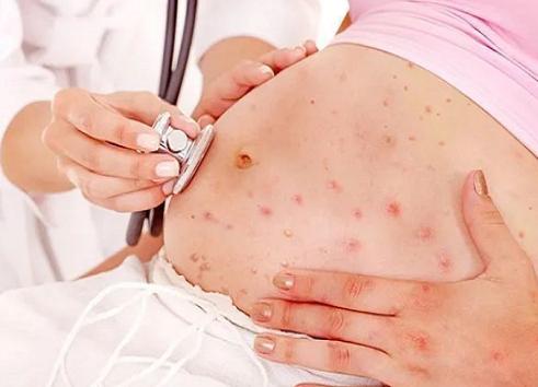 孕12周孕妇得口腔疱疹导致胎儿畸形的概率有多高？