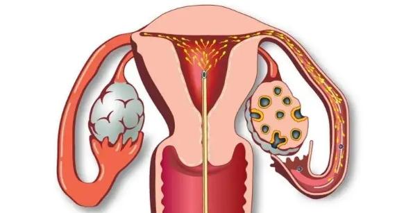 女性在做完人工授精之后的注意事项有哪些？