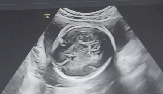 内分泌失调在咸阳做一次试管婴儿要多少钱?