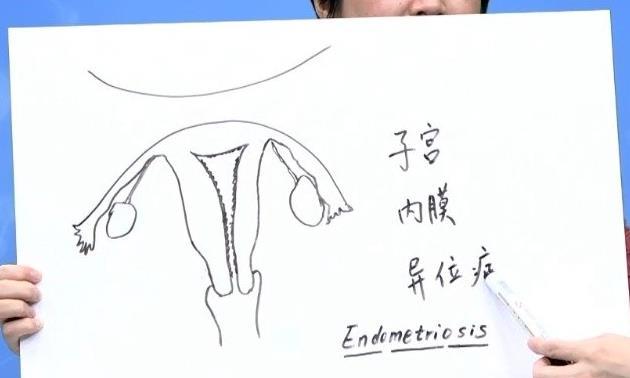 患有子宫内膜异位症，应该如何安排移植？
