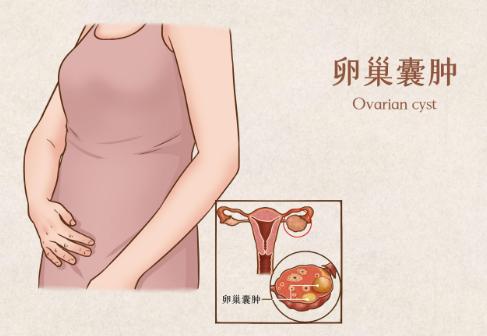 患有卵巢囊肿做试管的成功率有多少？