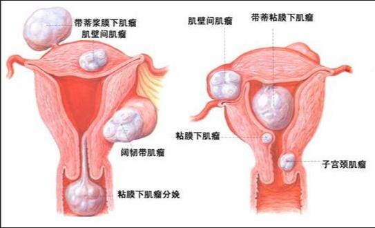 轻微子宫内膜炎试管失败两次第三次移植会成功吗?是否存在其他的辅助生育技术或治疗方法?