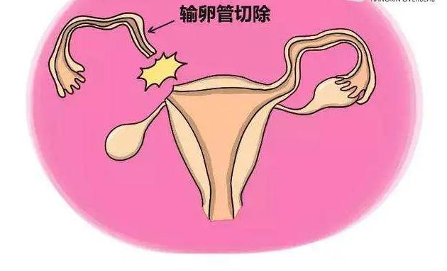 双侧输卵管切除去格鲁吉亚试管会比去美国更优惠吗？