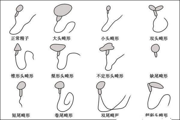 精子密度下降去陆军总医院做试管需要排队等多久？过程复杂吗？