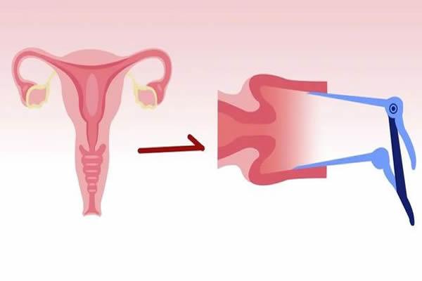 试管婴儿移植前都要做宫腔镜检查吗？