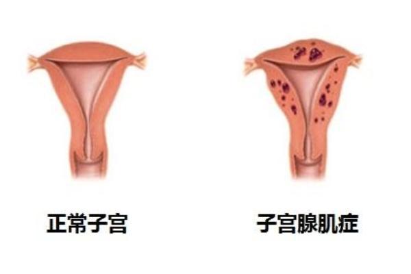 子宫腺肌症在济南做试管能一次成功吗?