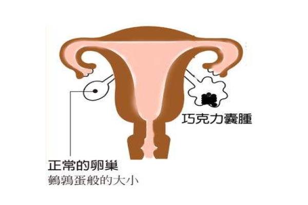 患有左侧卵巢囊肿在济南做供卵试管婴儿的费用是多少?