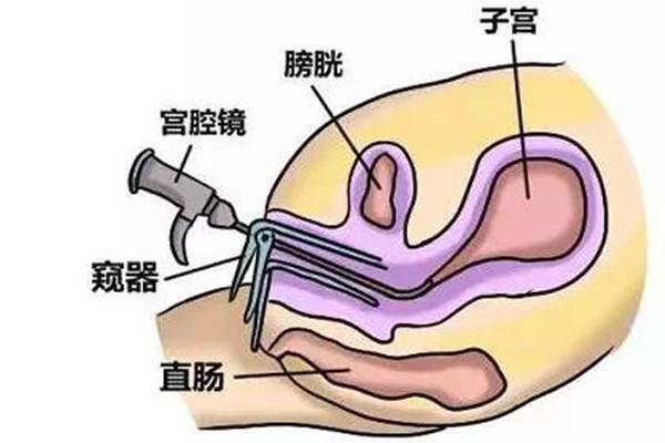 宫腔粘连患者在武汉哪家医院做试管婴儿成功率高?