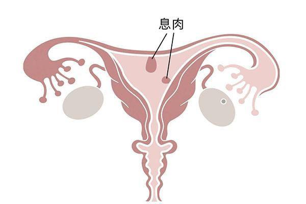 子宫息肉患者在山东可以做试管婴儿吗？能包生男孩吗？