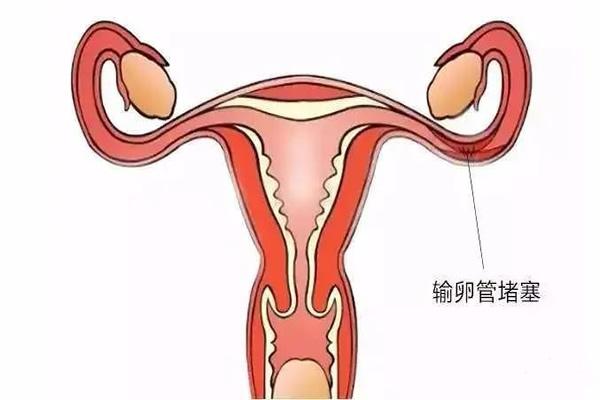 女方右侧输卵管堵塞调养后可以做试管婴儿吗?如何提高成功率?