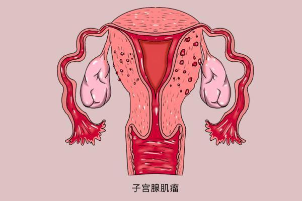 患有子宫肌瘤在美国做三代试管婴儿应该选择什么促排方案?