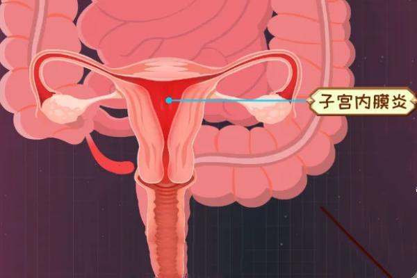 子宫内膜炎患者在石家庄做试管婴儿怎么样?如何选择合适的医院?