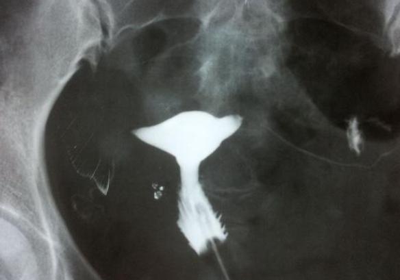 宫颈炎会对输卵管造影有什么影响呢？