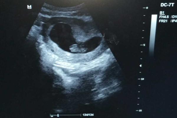 为什么试管婴儿胎芽胎心出现时间比较晚?