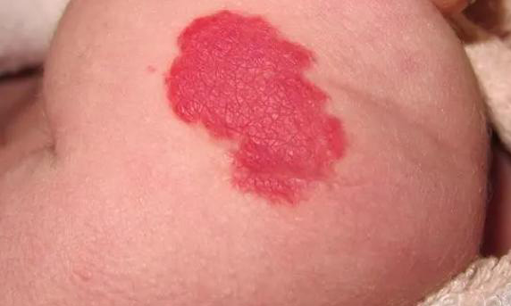 婴儿血管瘤初期的表现是什么？