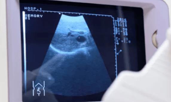 孕期比较后一次做b超时间应该安排在37周做好还是38周?