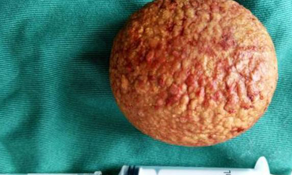 膀胱结石可以通过那些方法治好?