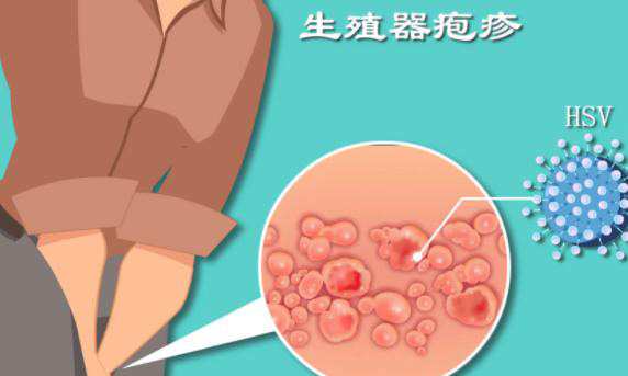 复发性生殖疱疹能通过做试管生孩子吗?