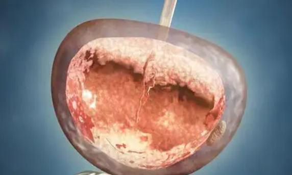 30岁多囊适合做三代试管吗?成功率高不高?