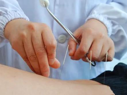 试管移植后做针灸理疗对身体有什么好处？比较多能做几次你知道吗？