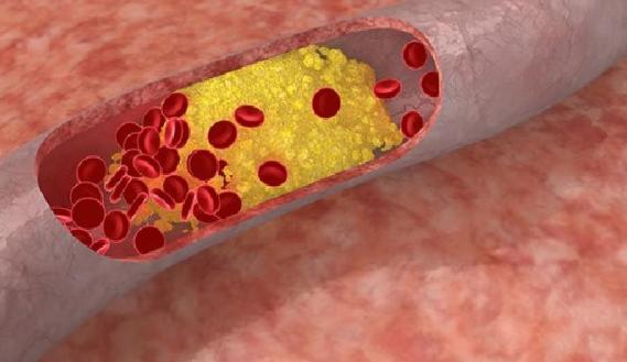 湿锐尖如何自己判断,原因是什么