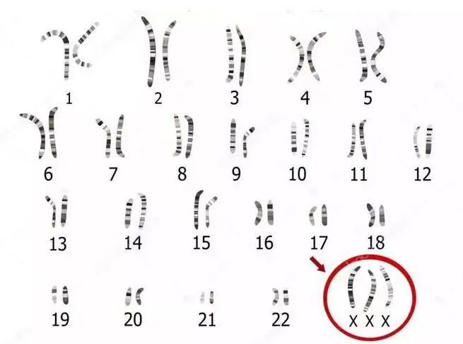 超雌综合症是罕见的基因病，患者大都十分漂亮
