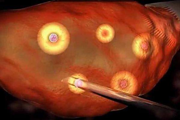 试管取卵取了35个成熟卵泡,会不会出现中重度腹水?