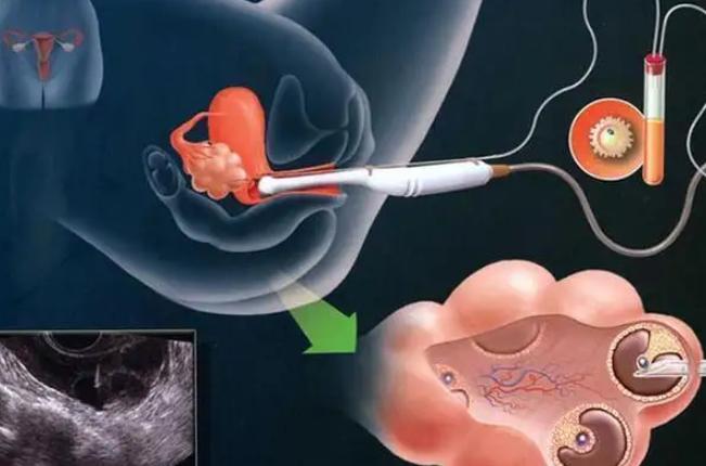 试管取卵要注意,注意事项望周知