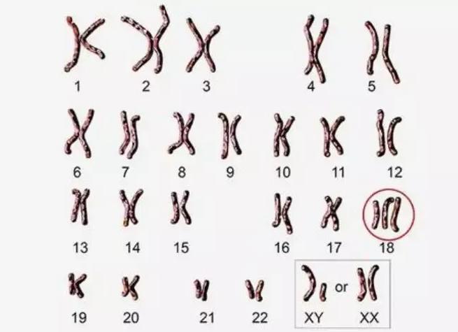 小头畸形，可能是14号染色体异常导致的