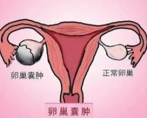 有卵巢囊肿可以做三代试管婴儿吗？