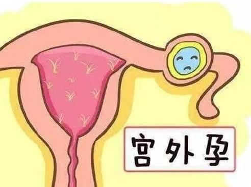 试管移植后也会出现宫外孕，导致宫外孕的主要原因是这些