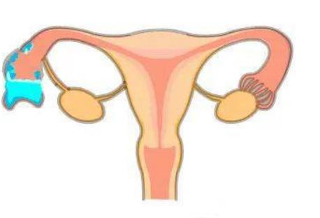 输卵管积水需要切除输卵管吗，有其他的方式可以进行治疗吗