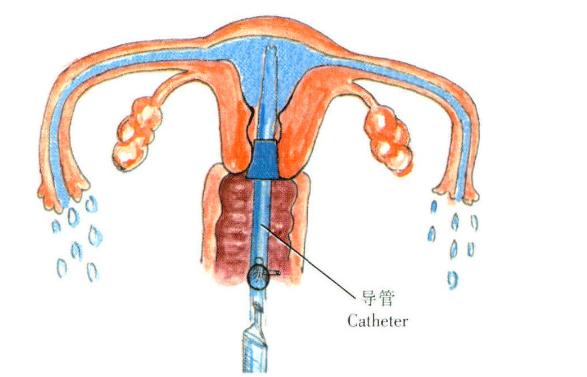 什么是输卵管通水?输卵管通水术要做几次?