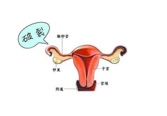 输卵管破裂的症状是什么？如何及时发现和治疗？