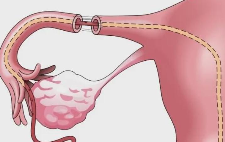 输卵管手术需要开刀吗?输卵管做手术大概多少钱?