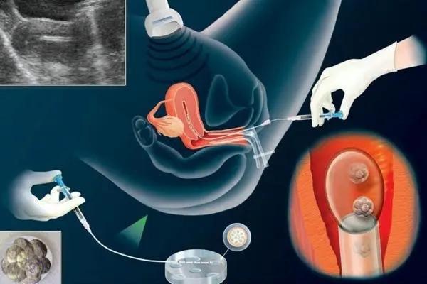 试管婴儿人工周期步骤，什么叫试管婴儿人工周期