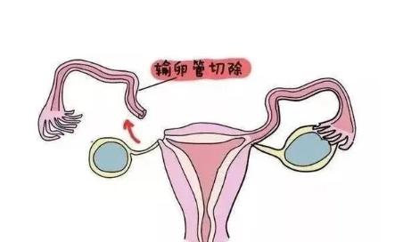 输卵管切除多久可以同房过夜?输卵管切除后需要注意什么？