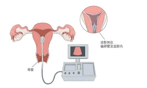 输卵管检查怎么检查?输卵管检查有哪些?