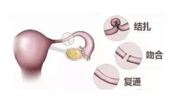 结扎复通手术痛不痛?结扎复通可以微创吗?