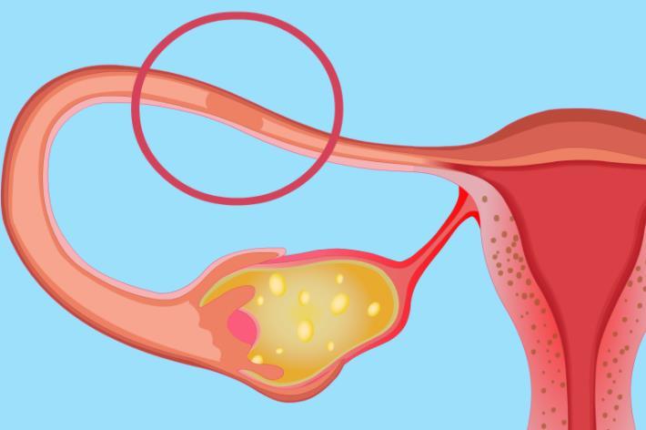 输卵管堵塞比较佳治疗方法介绍，附费用及注意事项