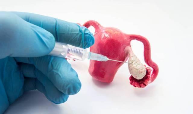 引起输卵管积水的原因有很多，建议平时按时体检