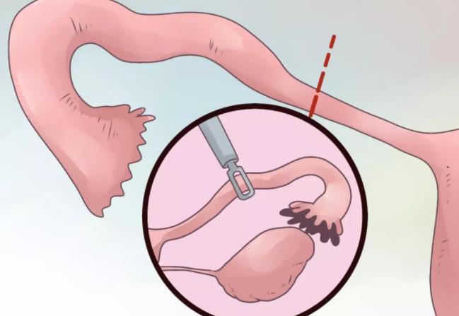 输卵管堵塞手术是自费还是报销？还要看当地医保政策