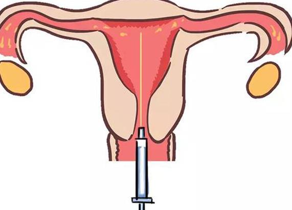 试管取卵环节至关重要，千万不要忽视