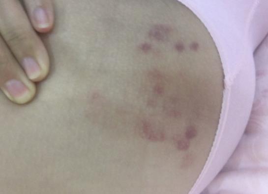 孕妇产后身上长红斑是常见现象,试试提前做好这些预防