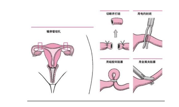难以逆转?女性做输卵管结扎的危害,你知道吗?