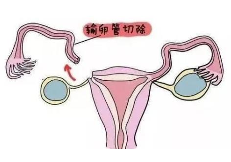双侧输卵管切除会女性生育有影响，但也能通过这些方式进行生育