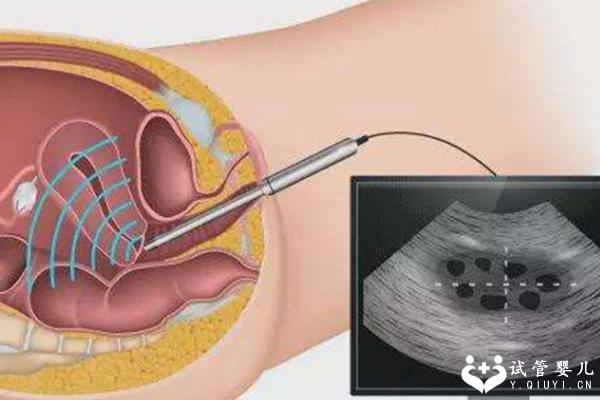 卵巢囊肿不治直接做试管好不好？移植成功率是多少？